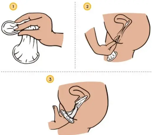 Ilustración en tres pasos sobre la colocación del condón femenino: 1) se sostiene el anillo interno, 2) se introduce en la vagina, 3) se acomoda cubriendo el cuello uterino.