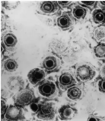 Micrografía electrónica del virus herpes simple, mostrando partículas virales con estructura icosaédrica y cápside densa.