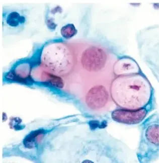 Fotografía microscópica circular de diplococos rojos (Neisseria gonorrhoeae)