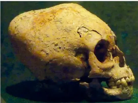 Fotografía de perfil de un cráneo humano deformado, con la parte superior y trasera alargadas, de color hueso amarillento, sobre un fondo oscuro.