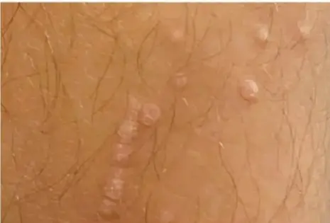 Fotografía de piel con verrugas genitales o anales, síntoma característico de algunos tipos de VPH.
