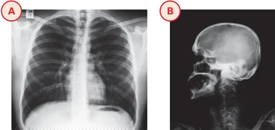Radiografía frontal del tórax: se distinguen las costillas curvas, la columna vertebral central, las clavículas y el esternón, además de las sombras de los pulmones.
