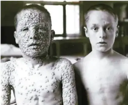 Fotografía en blanco y negro de dos niños con lesiones cutáneas por viruela; uno de ellos presenta numerosas pústulas en el rostro y el cuerpo.