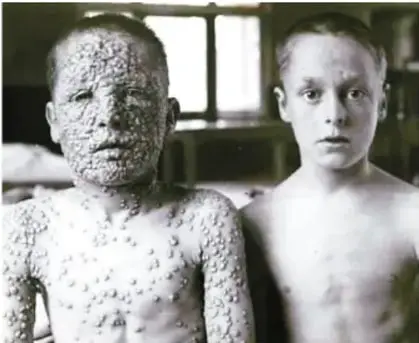 Fotografía en blanco y negro de dos niños con lesiones cutáneas extensas por viruela.