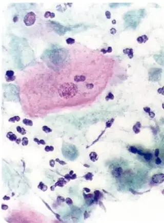 Microfotografía rectangular de una muestra con células y el parásito Trichomonas vaginalis teñidos.