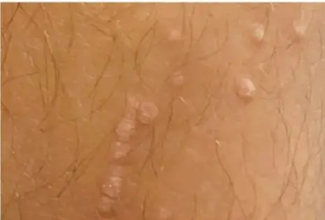 Fotografía de la piel con verrugas genitales o anales producidas por el VPH.