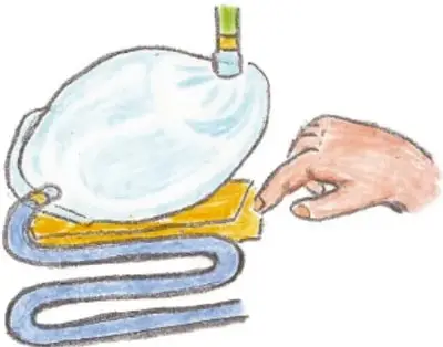 Manos pegando una manguera azul larga y ondulada a la bolsa-estómago; la manguera representa el intestino delgado.