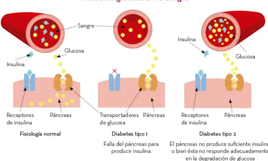 Infografía titulada 'Niveles de glucosa en la sangre' que compara fisiología normal, diabetes tipo 1 y diabetes tipo 2, mostrando vasos sanguíneos, células, receptores de insulina, transportadores de glucosa y páncreas.