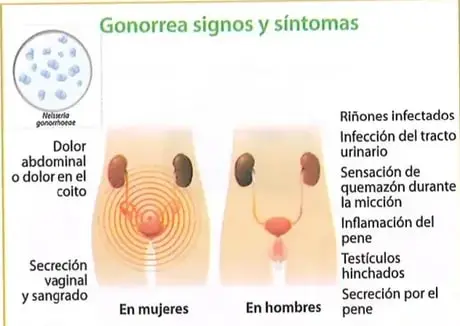 Infografía sobre los signos y síntomas de la gonorrea en mujeres y hombres.