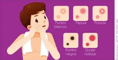 Ilustración de un joven con ejemplos de tipos de acné: puntos blancos, pápula, pústula, puntos negros y quiste nodular.