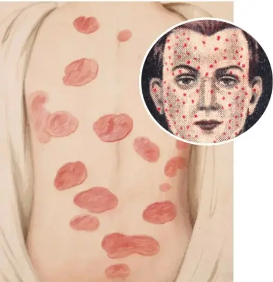 Fotografía de la espalda de una persona con múltiples lesiones rojizas de viruela, junto a un círculo con el rostro de un hombre cubierto de marcas de la enfermedad.