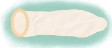 Ilustración de un DIU en forma de T con hilos.