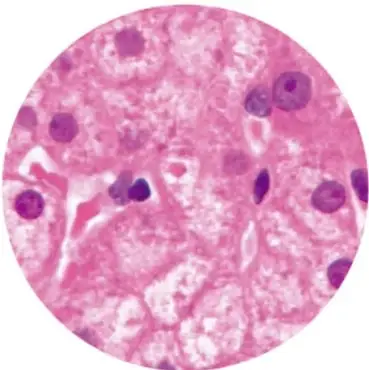 Microfotografía circular de tejido hepático teñido (células del hígado en inflamación).